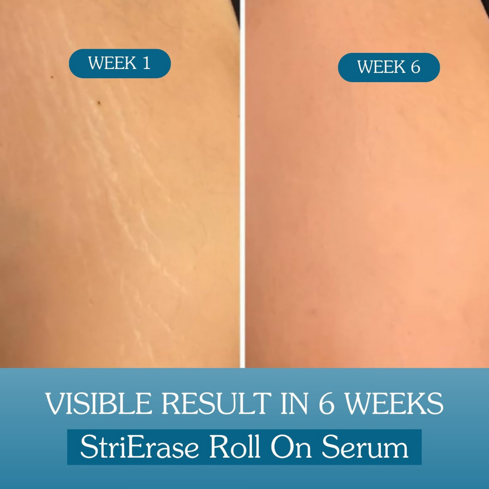 Bake StriErase™ Stretch Marks Removal Roll-On Serum | Grocsy