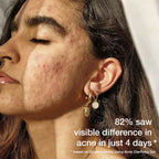 Skog Acne Clarifying Gel | Grocsy