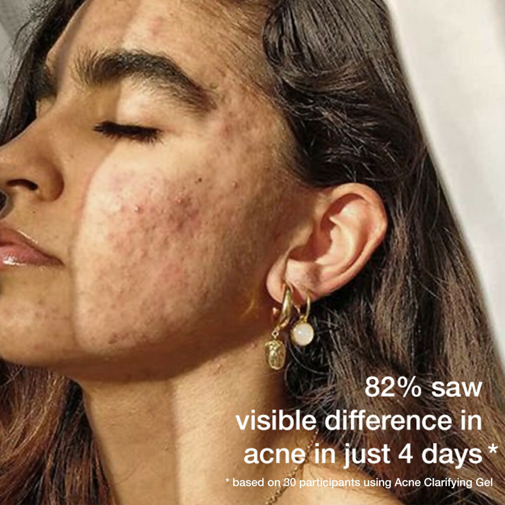 Skog Acne Clarifying Gel | Grocsy