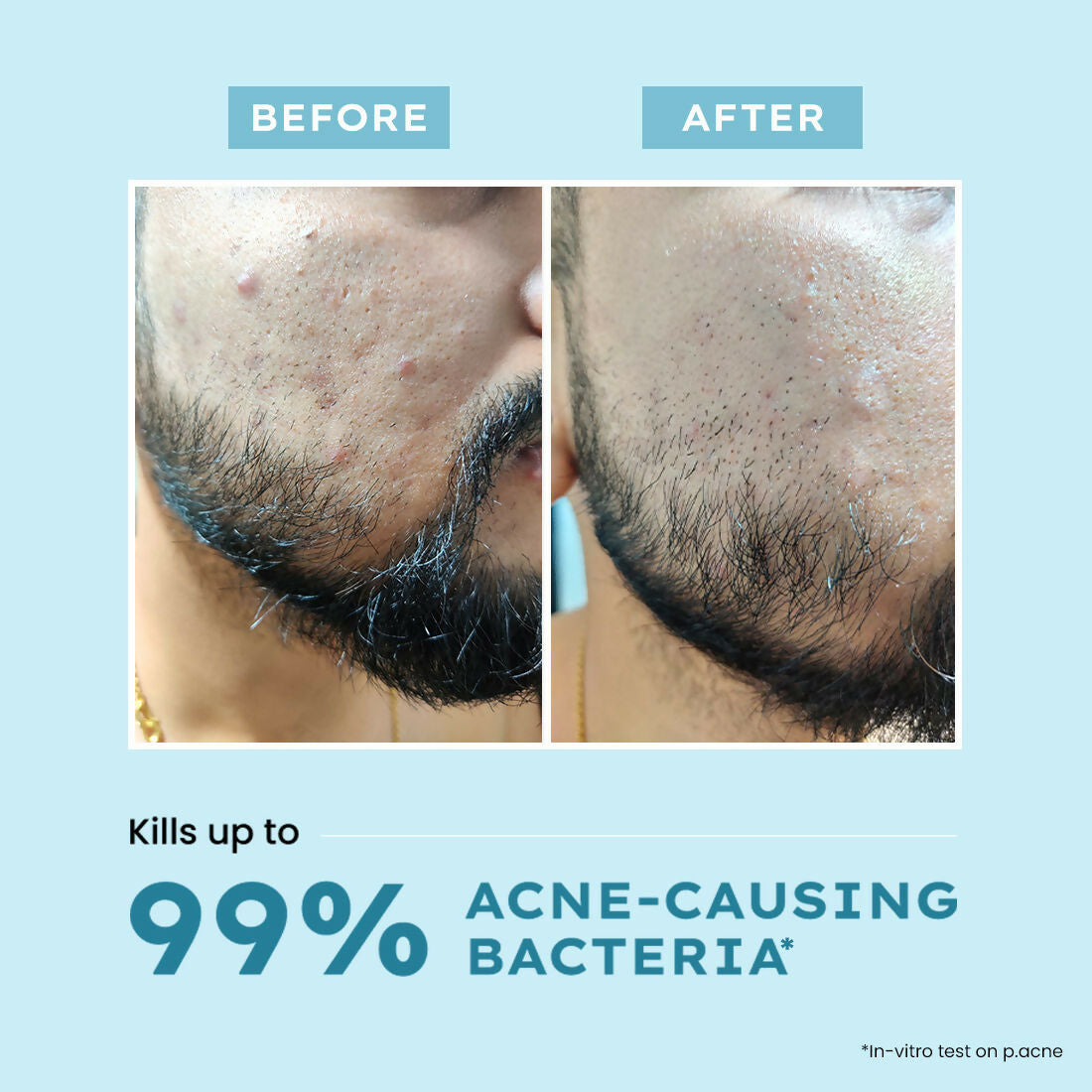 Hyphen By Kriti Sanon Acne Fix Spot Corrector, Shrinks Active Acne, Soothes Skin | Grocsy