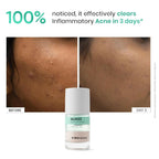 SkinInspired AcNil3 Rapid Spot Corrector | Grocsy
