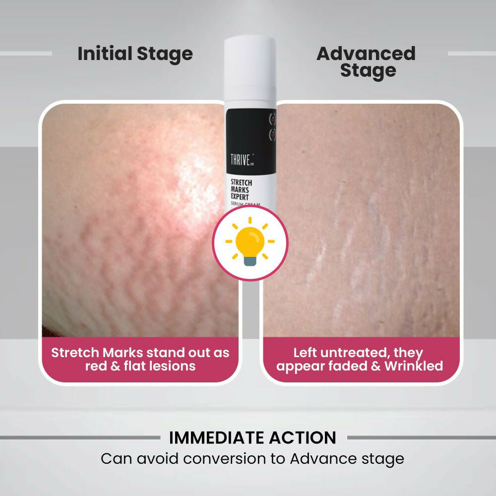 ThriveCo Stretch Marks Expert Serum Cream | Grocsy