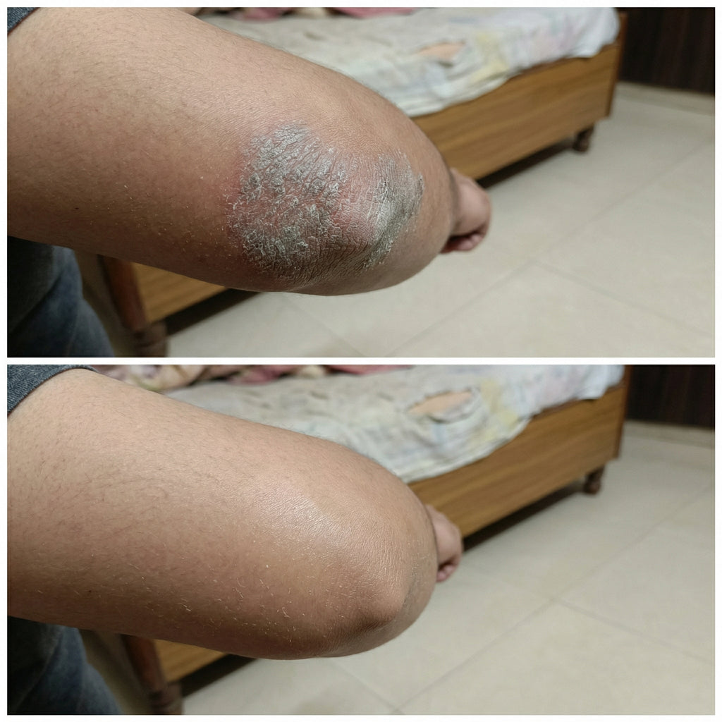 Vedicderm Psoriasis Cream | Grocsy