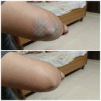 Vedicderm Psoriasis Cream | Grocsy