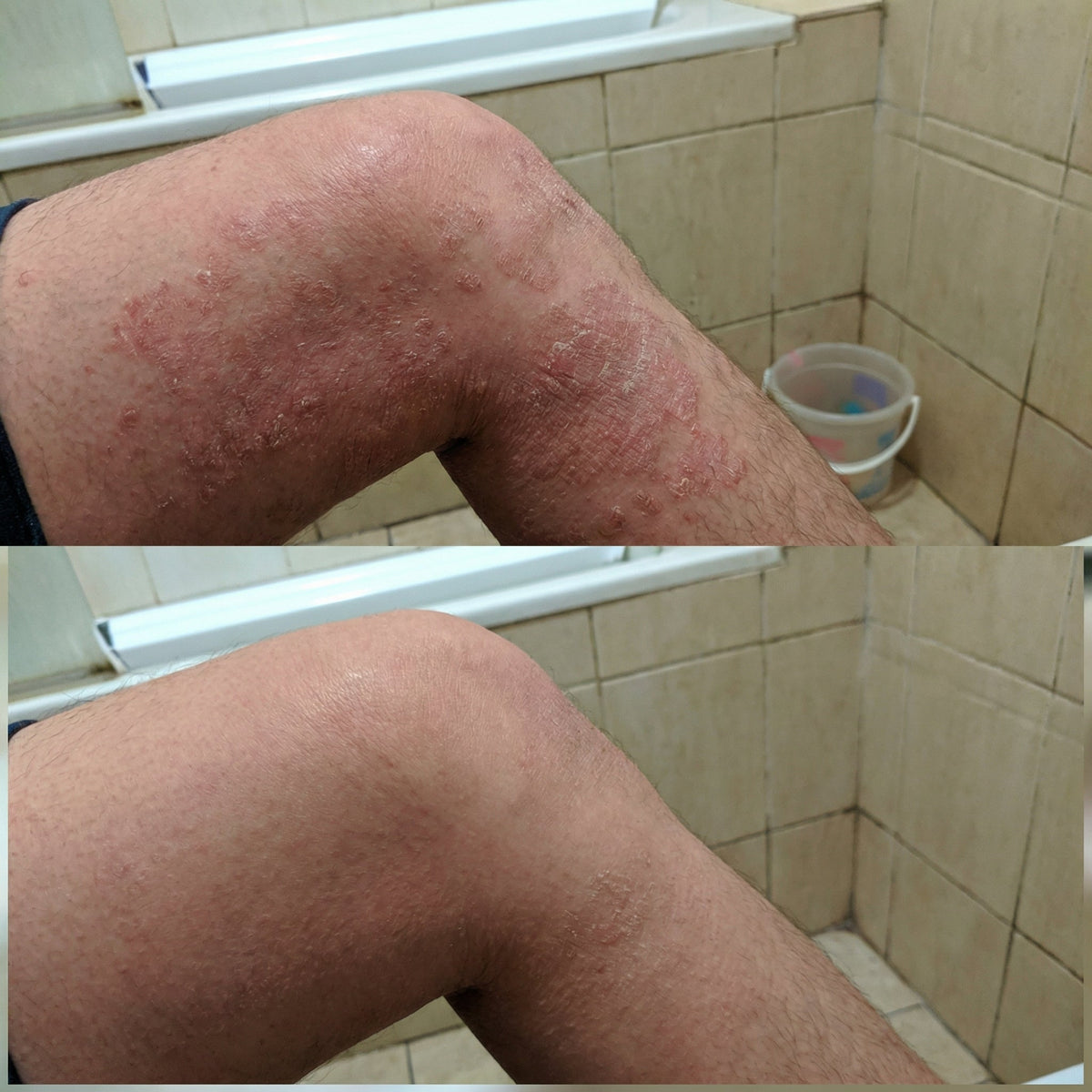 VedicDerm Sensitive Skin Bundle for Psoriasis, Eczema, Atopic Dermatitis | Grocsy