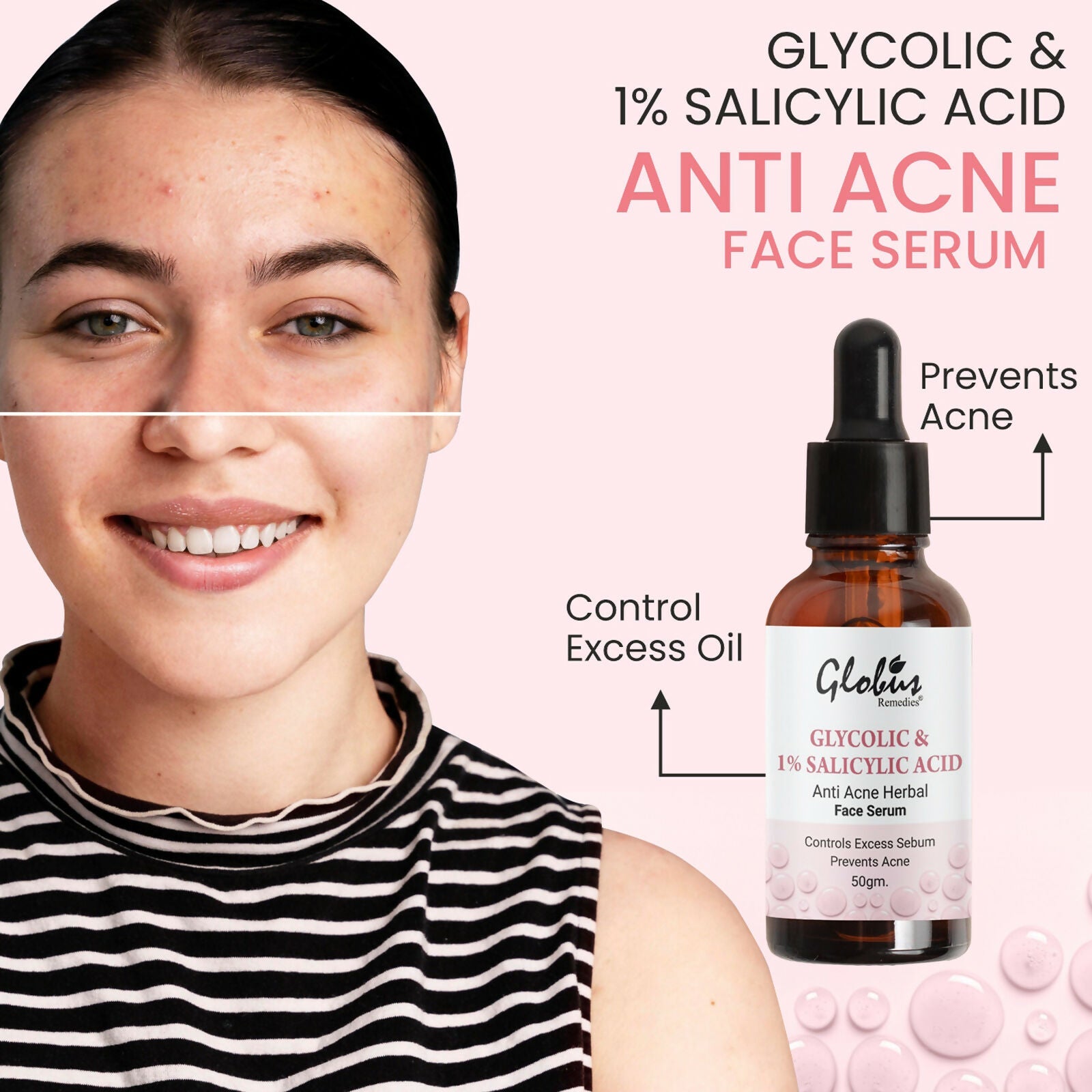 Globus Remedies Glycolic & 1% Salicylic Acid Anti Acne Face Serum | Grocsy
