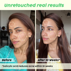 PLIX The Plant Fix Jamun Active Acne Kit With Spf 50+ Sunscreen & Juicy Cleanser | Grocsy