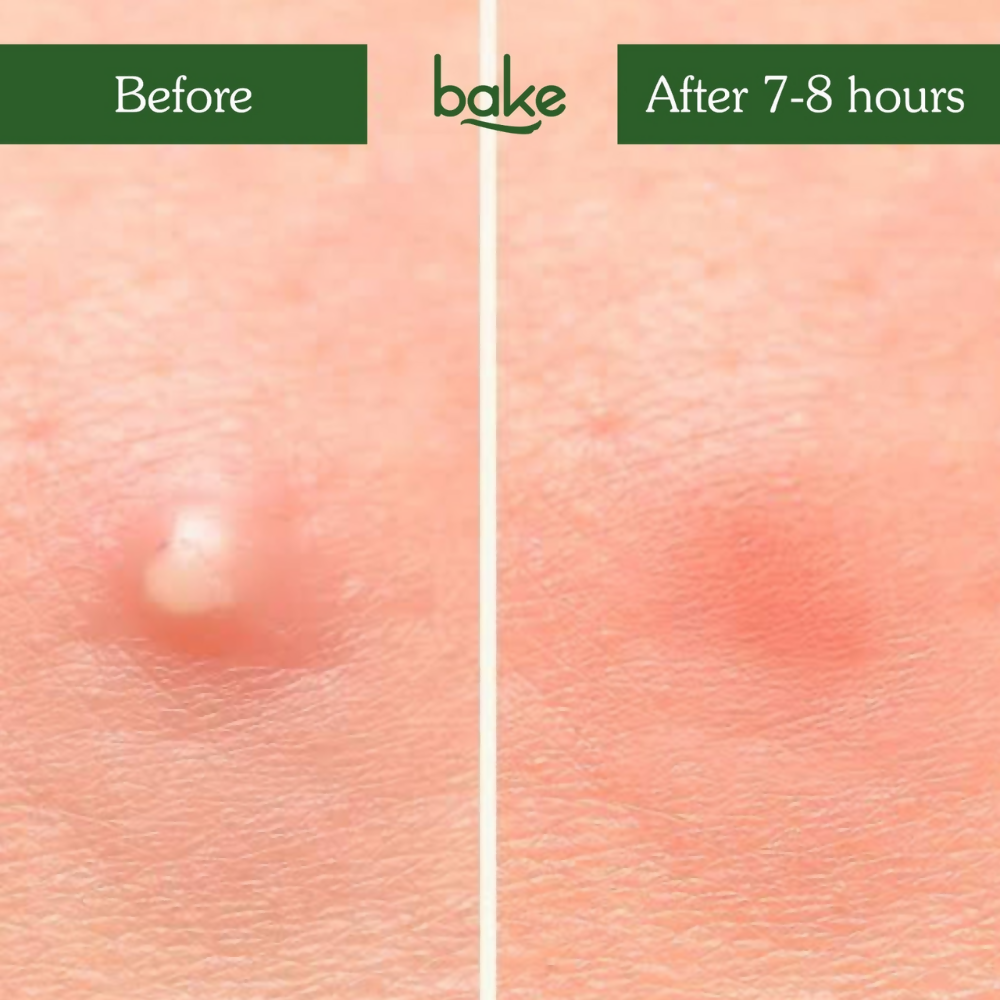 Bake Zit Erase Micro point Patches for Active Acne & Breakouts | Grocsy