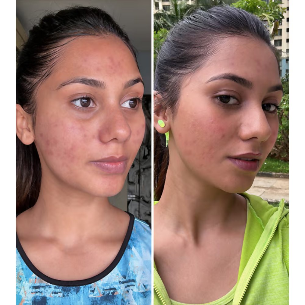 PLIX The Plant Fix 2% Acne Buster Moisturizer & 10% Niacinamide Serum | Grocsy