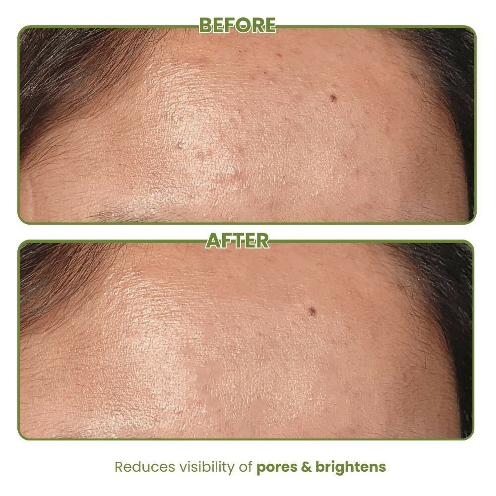 The Skin Diet Company Matcha Green Tea Toner Hydrates, Clarifies Pores, Alcohol-Free, For Oily Skin | Grocsy