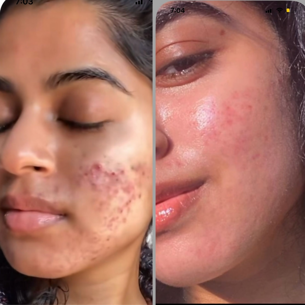 House of Beauty Acne Drying Serum | Grocsy