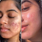 House of Beauty Acne Drying Serum | Grocsy